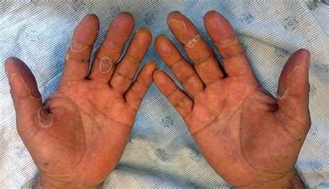 Hyperkeratotic Peeling Palms And Soles After Chemotherapy Clinical