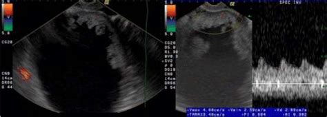 Serous Cystadenocarcinoma Of Ovary Cystic Mass With Papillary