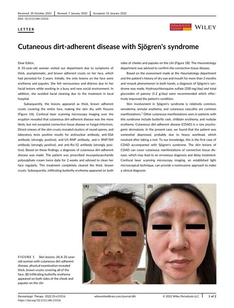 Cutaneous Dirt‐adherent Disease With Sjögrens Syndrome