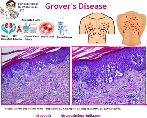 Pathology Of Grovers Disease 2022 Dr Sampurna Roy Md