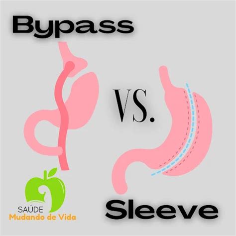 Cirurgia Bariátrica Bypass Vs Sleeve Entendendo As Diferenças E