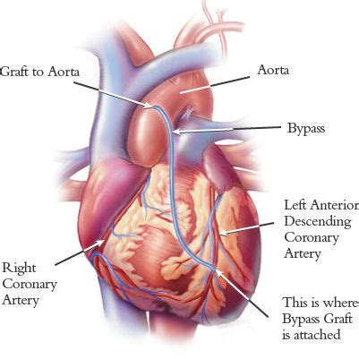 Coronary Artery Bypass Surgery CABG Heart Bypass Surgery AHVC