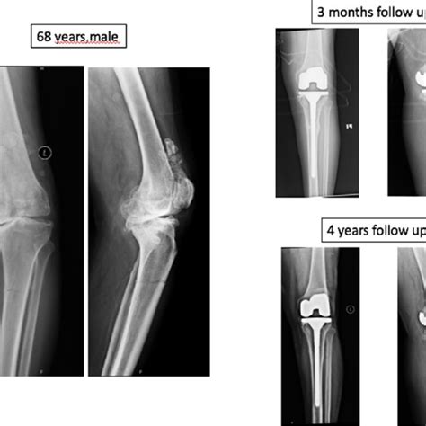 Two Level Stress Fracture With Malunion At Stress Fracture Site Treated