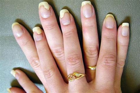 Fingernail Fungus Causes Treatment Nail Ftempo