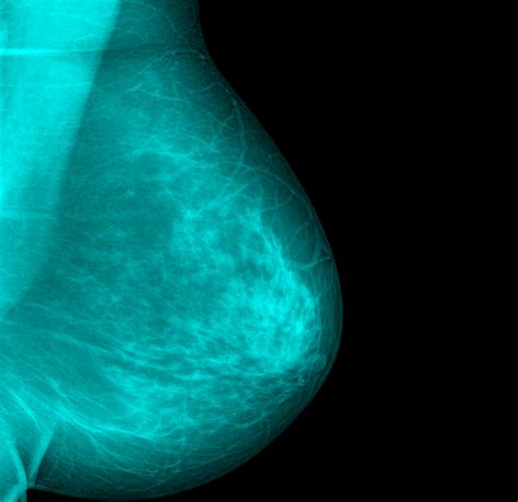 Inflammatory breast cancer (ibc) is a rare and aggressive form of breast cancer that occurs when malignant cells block the lymph vessels in the skin of the breast. Earliest Breast Cancer Surgeries May Soon Be Bit Easier