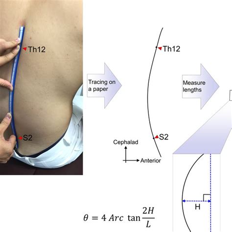 Schema For Calculation Of The Lumbopelvic Sagittal Alignment With