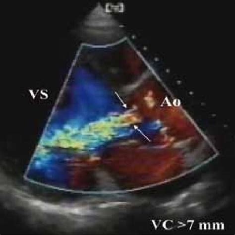 At Surgical Inspection The Quadricuspid Aortic Valve Appears To Be Download Scientific Diagram