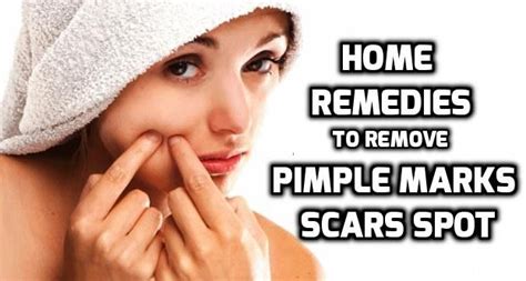 How To Remove Pimple Marks And Acne Marks From Face
