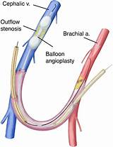 A Balloon Angioplasty Is Used To Pictures