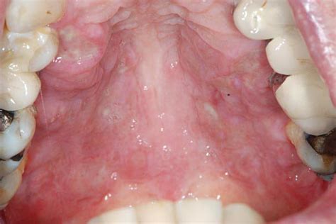 Erythema Multiforme Oral Histology
