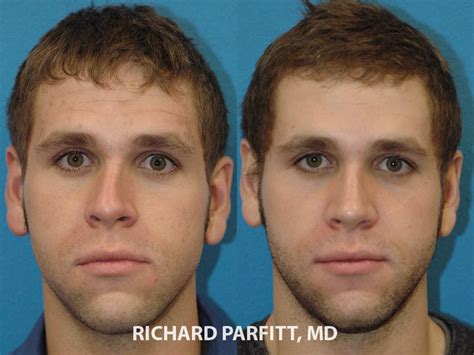 As a rhinoplasty specialist, dr hunt has performed hundreds of rhinoplasty surgeries on men throughout his 15 year career, both as primary rhinoplasty on his own patients, and secondary rhinoplasty correcting poor results from other surgeons. Male Plastic Surgery Before and After Photos