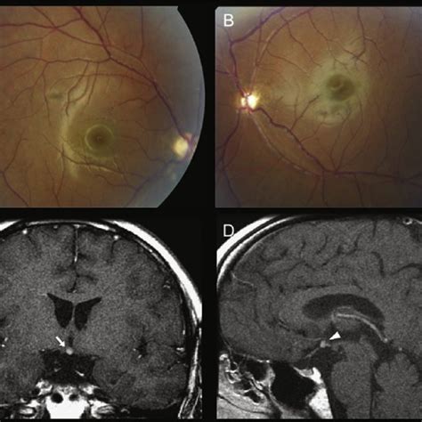 Bilateral Optic Nerve Hypoplasia Onh With Agenesis Of Septum
