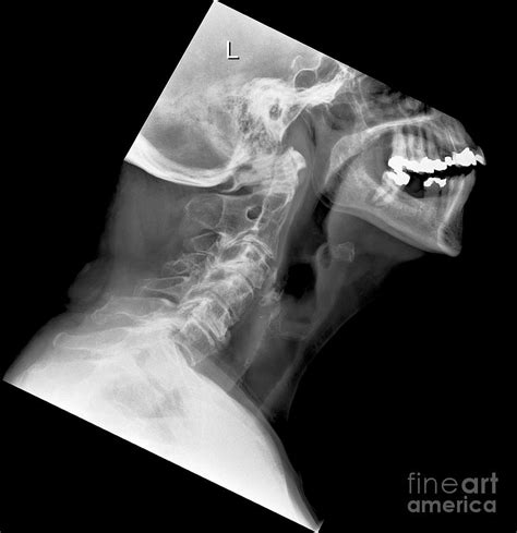 Arthritis Of The Neck X Ray Photograph By Science Photo Library