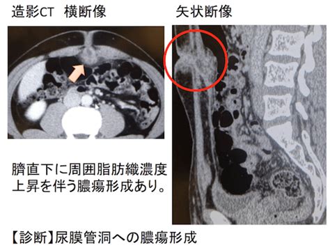 Manage your video collection and share your thoughts. 尿膜管遺残の画像所見(開存、嚢胞、洞、憩室、尿膜管癌、urachus)