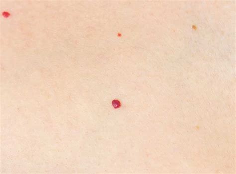 Cherry Angiomas Red Spots Laser Melbourne