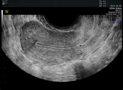 Drinking 8 to 10 ovarian cyst ct scan vs. Comparing Endometriosis vs. Endometrial Cancer | Empowered ...