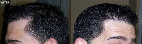 Fue Hairline Hair Restoration Grafts Alviarmani Hair