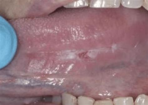 Detection Of Early Stage Oral Cancer Lesions A Survey Of California Dental Hygienists