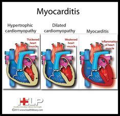 Myocarditis — and the serious symptoms associated with it — is myocarditis symptoms typically develop about one or two weeks after someone has a viral infection or another illness. 36 Myocarditis ideas | rheumatic fever, heart muscle ...