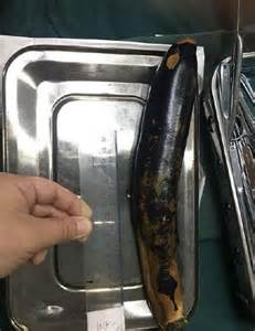 Doctors Remove Foot Long Aubergine From Mans Intestines After He