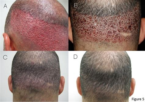 Hair Transplant World — Easy Understanding Of Male Pattern Baldness And