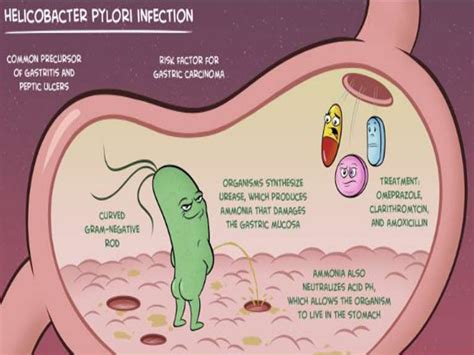 Natural Remedy For Helicobacter Pylori The Main Reason Which Causes The Formation Of Ulcers