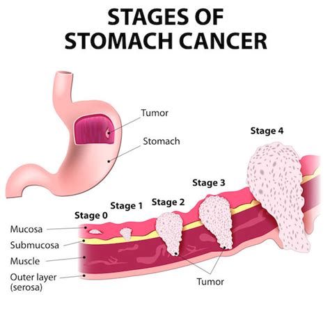 Stomach Cancer Causes Symptoms And Treatment Clicks Health Hub