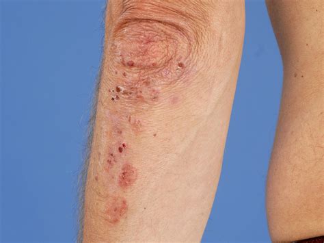 Dermatite Herpetiforme Diseasemaps Sexiz Pix