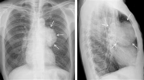 Imaging Of Thymus In Myasthenia Gravis From Thymic Hyperplasia To