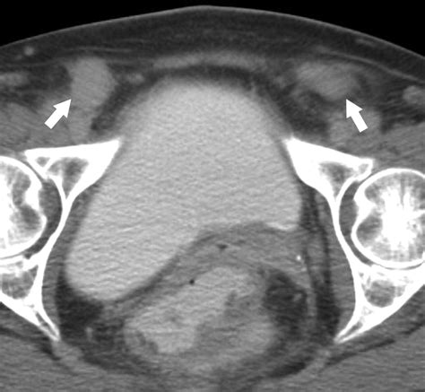 The Inguinal Canal Anatomy And Imaging Features Of Common And Uncommon