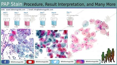 PAP Stain Introduction Principle Staining Procedure Result Interpretation And Keynotes