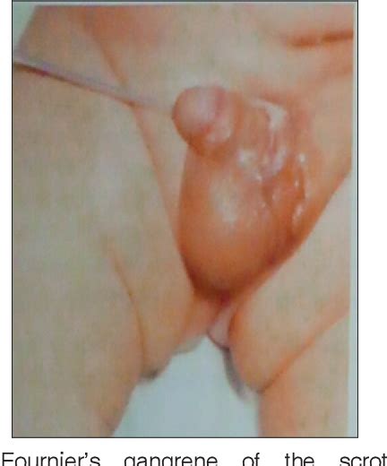 Neonatal Scrotal Wall Necrotizing Fasciitis Fournier Gangrene A Case My Xxx Hot Girl