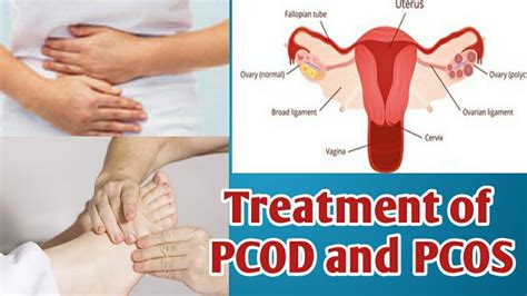 Treatment of PCOD and PCOS by Acupressure एकयपरशर स ठक कर PCOD and PCOS YouTube