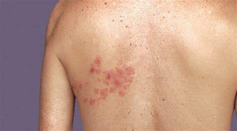 Shingles In Adults How To Recognize And Treat This Painful Condition