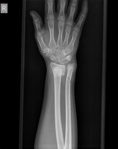 Forearm Fracture In A Child And Complete Triquetral Lunate Synostosis