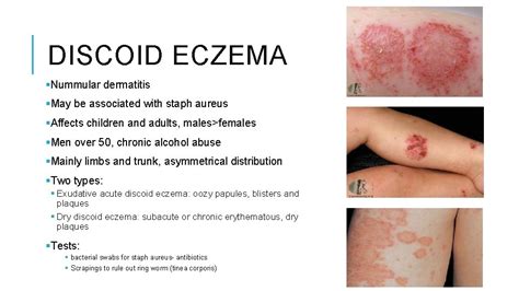 Eczema Learning Objectives Recognise The Features Of An