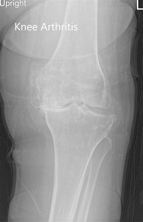 Case Study Bilateral Custom Total Knee Replacement In A 72 Year Old Male