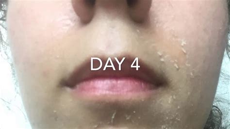 Glycolic Acid Peel 30 Process Day By Day Youtube