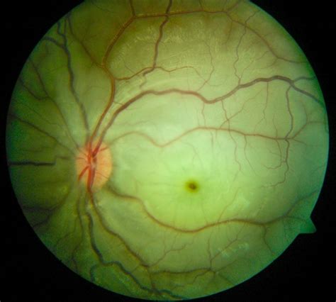 Central Retinal Artery Occlusion Retina Image Bank