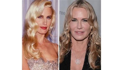 Worst Cases Of Celebrity Plastic Surgery Gone Wrong Page Of