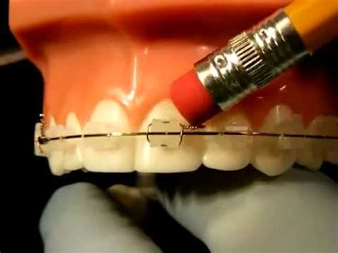 Bracesquestions Com Braces Problems Pain Poking Wire Sore Teeth