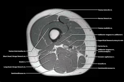 Upper Thigh Mri Anatomy Figure 1 From Normal Mr Imagi
