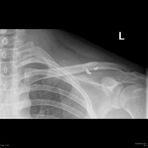 Clavicle Fracture Image