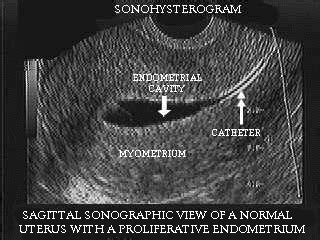 By tracking your basal body temperature each day, you may be able to predict when you'll ovulate. Sonohysterography - Google Search | Medical ultrasound ...