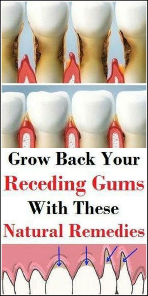 Grow Back Your Receding Gums With These Natural Remedies Receding