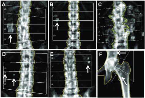 Illustration Of Six Examples Of Calcification On Dexa Imaging Arrows