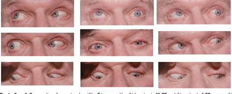 Figure 1 From Partial Third Cranial Nerve Palsy Clinical