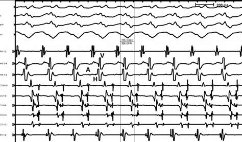 Two Cases Of Supraventricular Tachycardia After Accessory