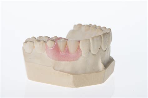 Single Tooth Denture One Tooth Denture Solution