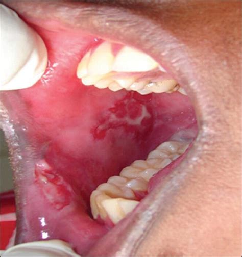 Oral Ulceration In Buccal Mucosa Of Pemphigus Vulgaris Download